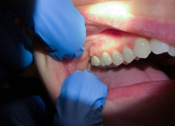 Best Emergency Dentist for Lost Fillings or Crowns in Sweeny, TX